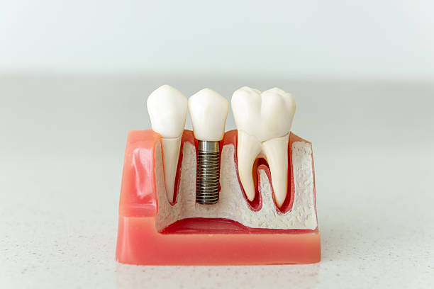 ¿Cuánto cuesta un implante dental en Barcelona?
