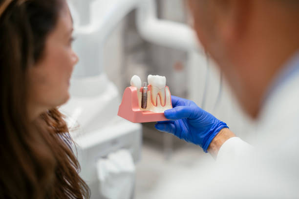 ¿Cuánto dura un implante dental?